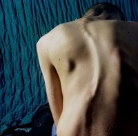 Scoliosis image